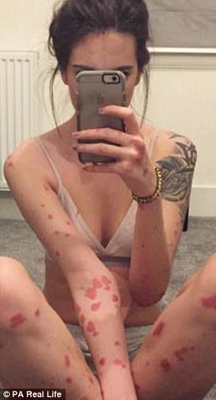 英国女大学生不堪考试压力 受顽固皮肤病折磨