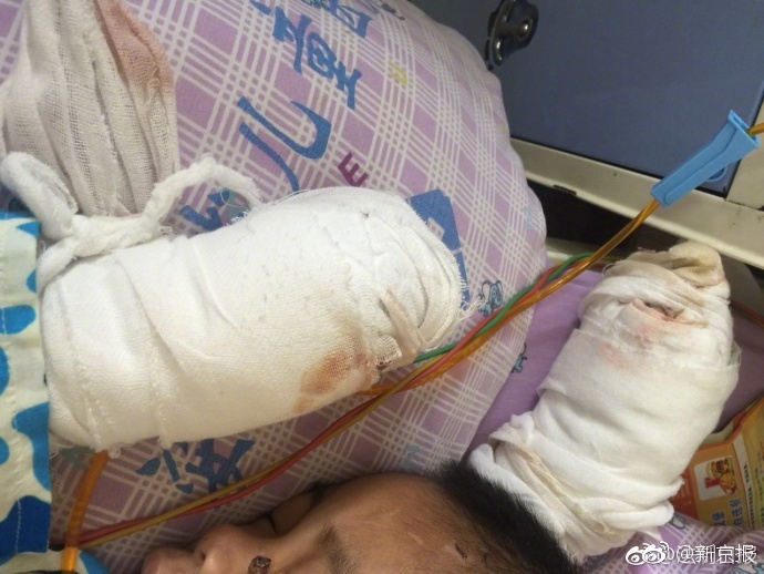 四岁半男童疑遭生母虐待 民警赶到后才被送到医院